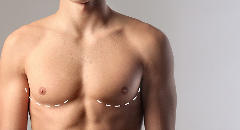 dr soner karaali jinekomasti 1